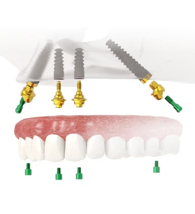 Riabilitazioni JD Full-Arch